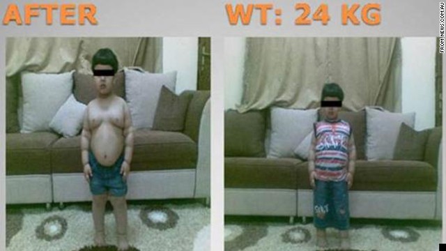 2 Year Old That Had Weight Loss Surgery
