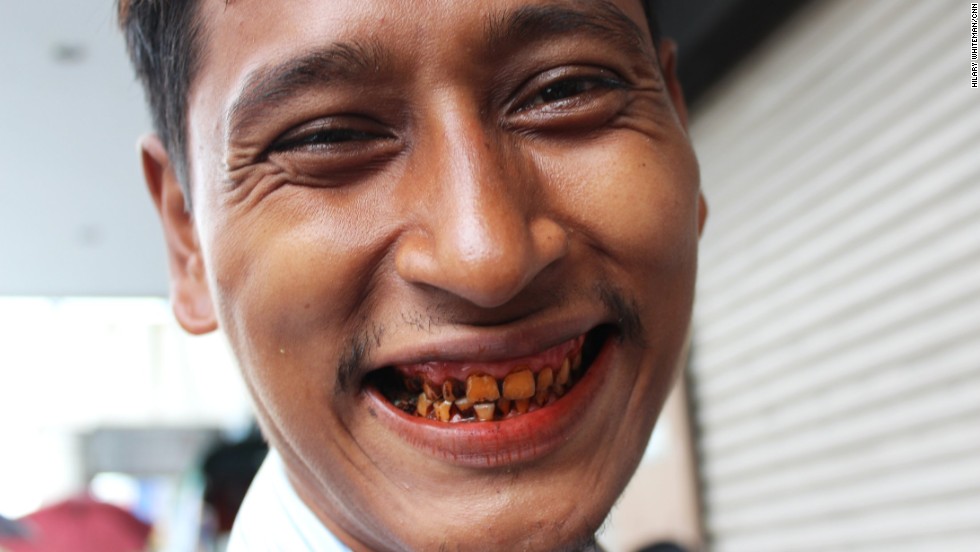 A man shows off his stained teeth, dyed red from years of chewing betel quids, potent parcels of areca nuts, lime and tobacco wrapped in a betel leaf. They give users a buzz when they&#39;re chewed but are also known to cause oral cancer.