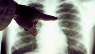 The lung cancer symptoms even nonsmokers need to know