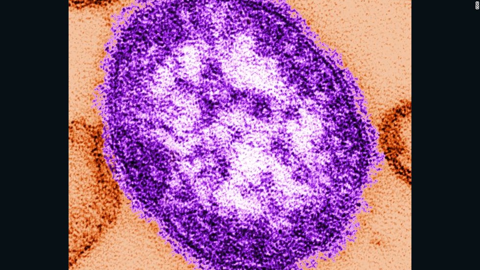 Measles outbreak strikes Minnesota's Somali community