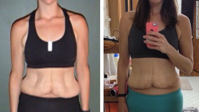 Teen Loses 100 Pounds Gets Tummy Tuck Cnn