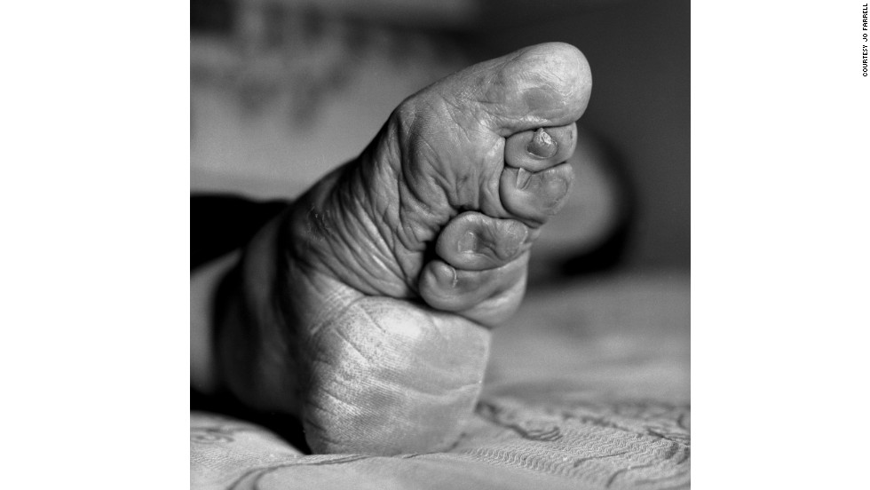 Last Living Women With Bound Feet 