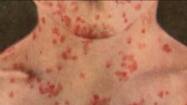 Measles Outbreak How Bad Can It Be 6321