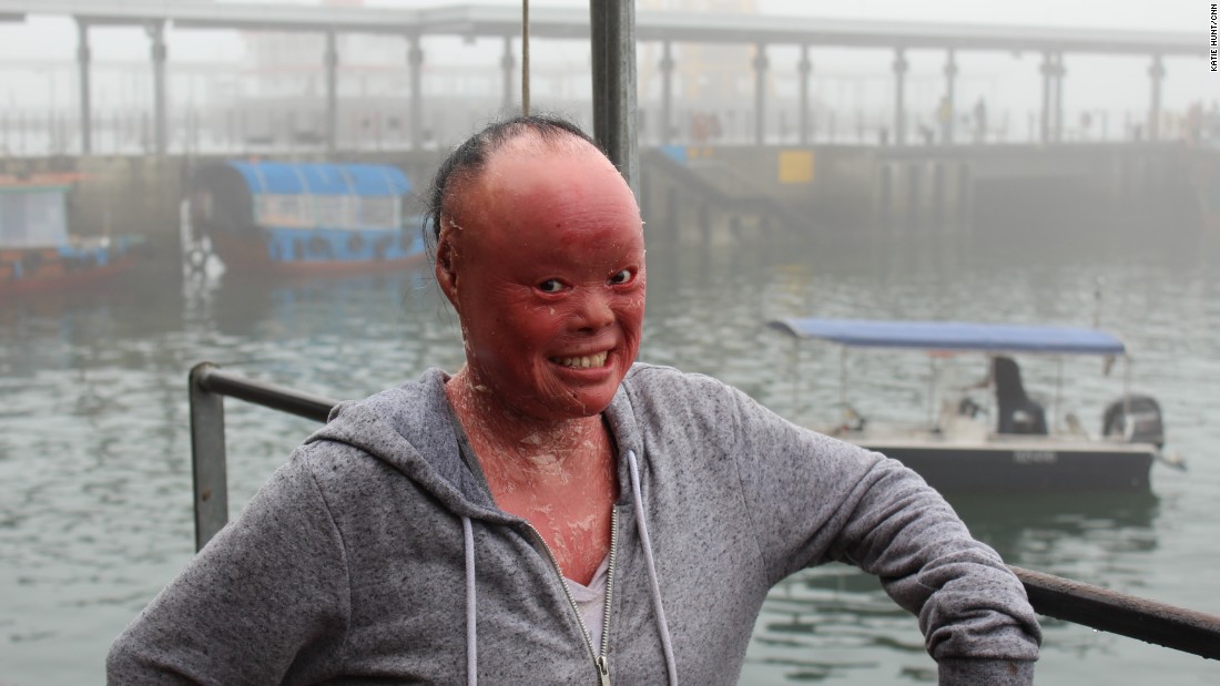 Mui Thomas battles skin disorder harlequin ichthyosis ...