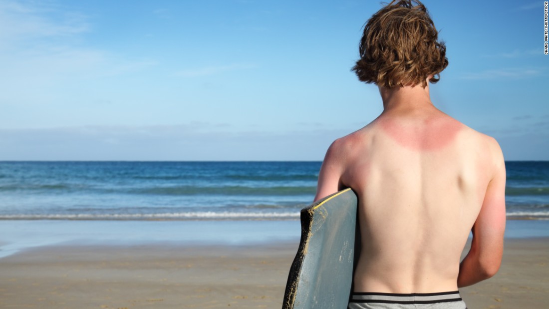 Tricks For Treating Your Sunburn Cnn Com