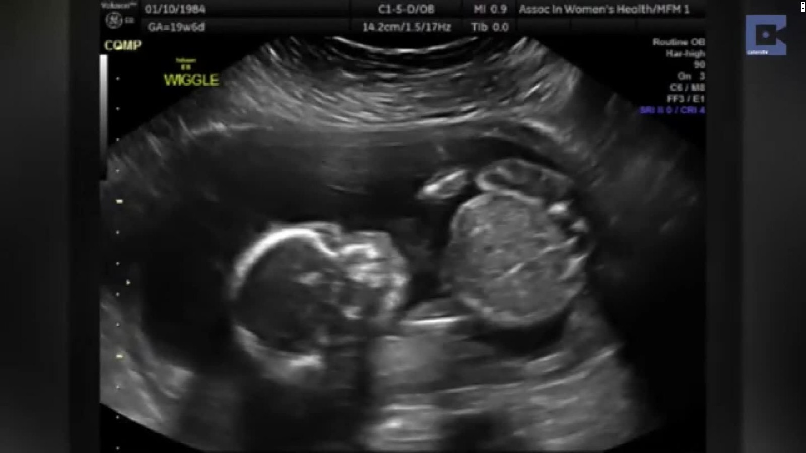 Baby Ultrasound Pictures 47