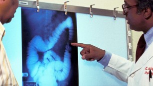 Good economy? More bowel cancers, study finds
