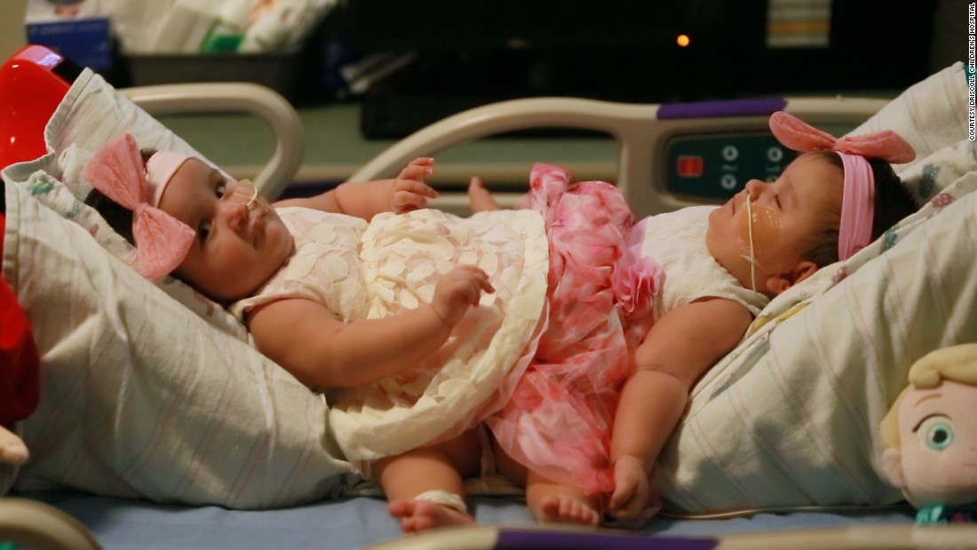 Conjoined Sisters Undergo Rare Separation Surgery Cnn 1445