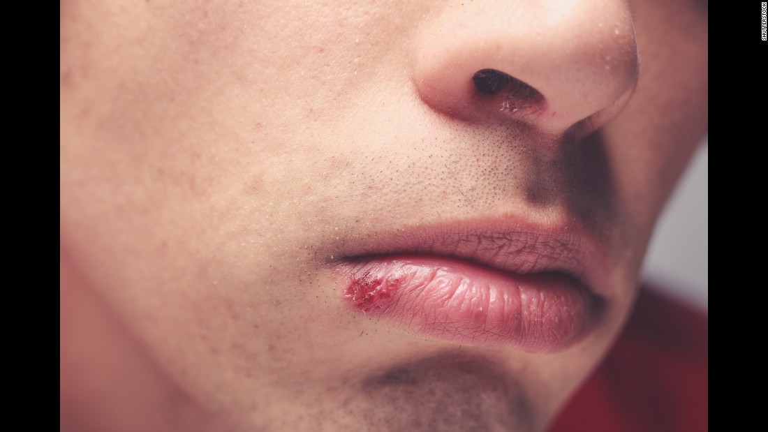 Herpes Sores Pop On Their Own