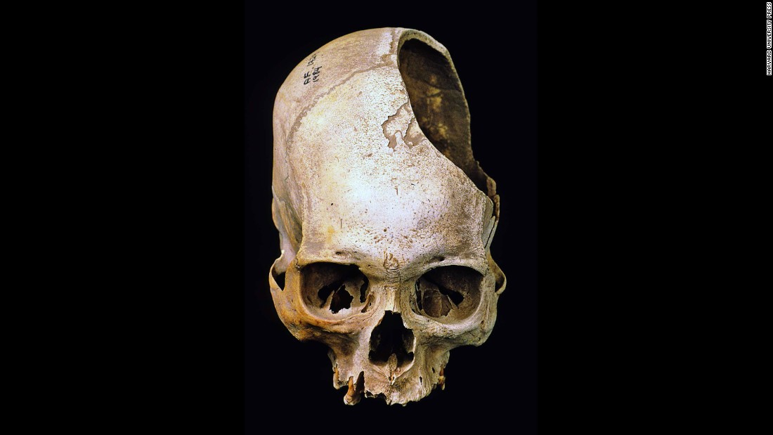 Were mystery holes in skulls an ancient aspirin? - CNN.com