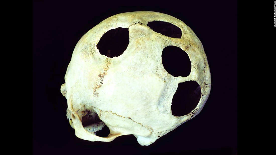 Were mystery holes in skulls an ancient aspirin? - CNN.com