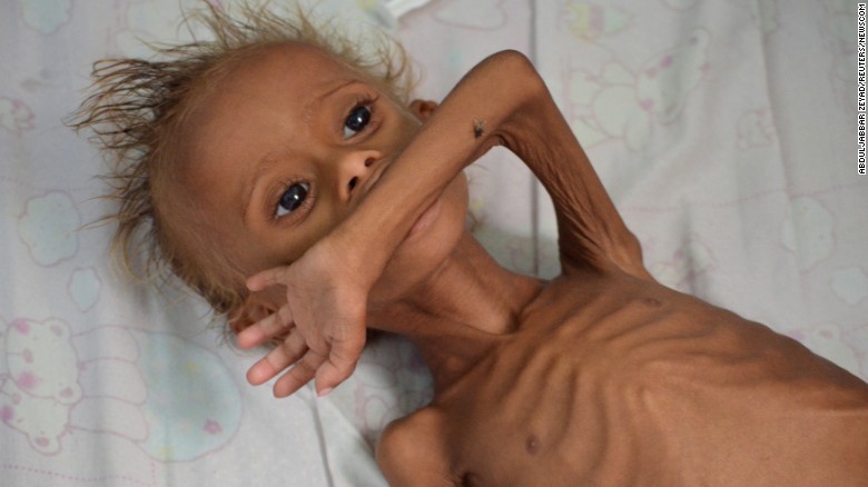 A malnourished boy lies on a bed at a hospital in the Red Sea port city of Houdieda, Yemen, in  September 2016.