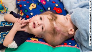 New life, apart: Rare surgery to separate brothers conjoined at head