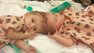 New life, apart: Conjoined twins separated in marathon surgery