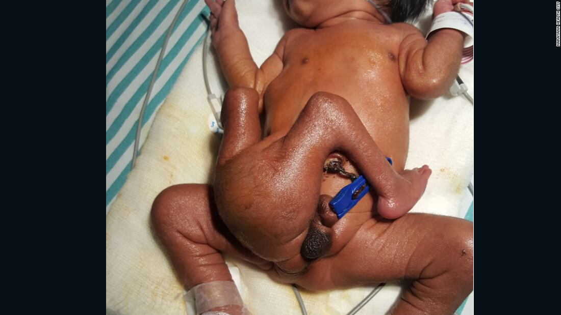 The baby was born with four legs and two penises.