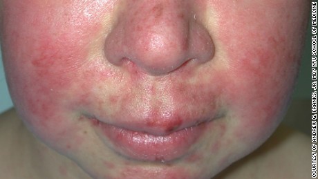 A &quot;butterfly rash&quot; on the face occurs in about half of cases.