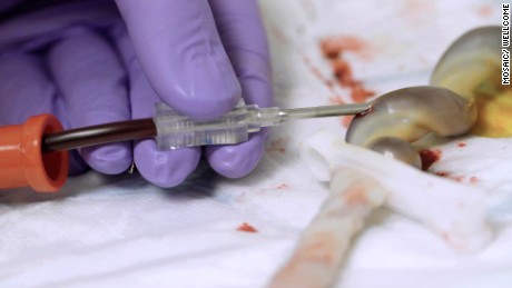 Blood is extracted from an Umbilical cord at UCLH in London.