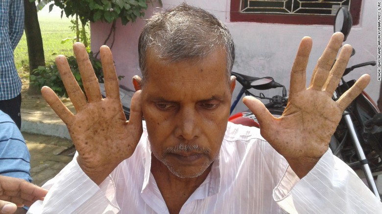 Ganesh Rai of Saran, Bihar, had acute keratosis, a symptom of arsenic poisoning. He died of kidney cancer at 58.