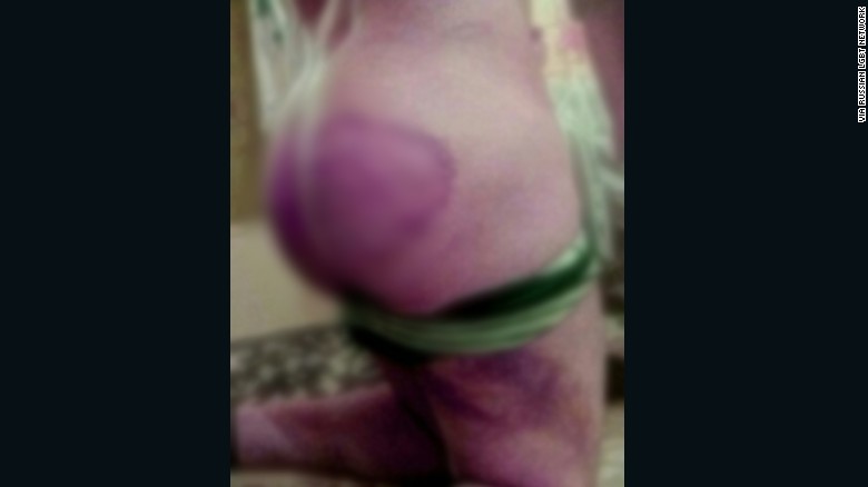 Severe bruising is seen on a man who says he was detained and abused for being gay in Chechnya.
