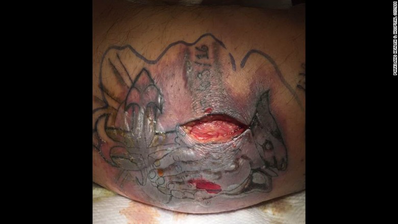 The tattoo two weeks after admission. The man was kept largely sedated for weeks.