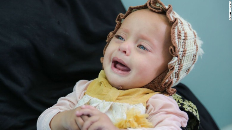 Yemen cholera outbreak grows, with children bearing brunt