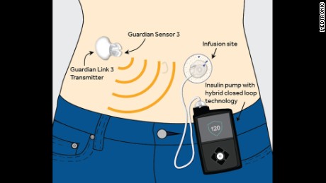 'Artificial pancreas' for type 1 diabetes wins FDA approval - CNN.com