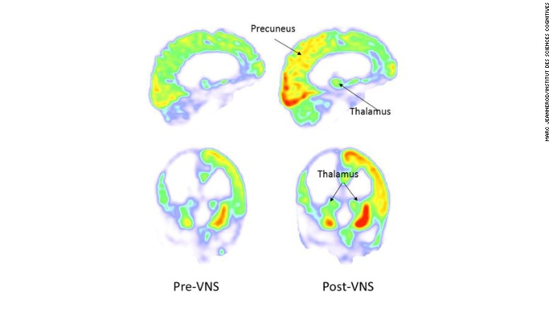 PET scan images of the brain show areas of the brain where glucose metabolism, necessary for mental function, increased following vagus nerve stimulation.